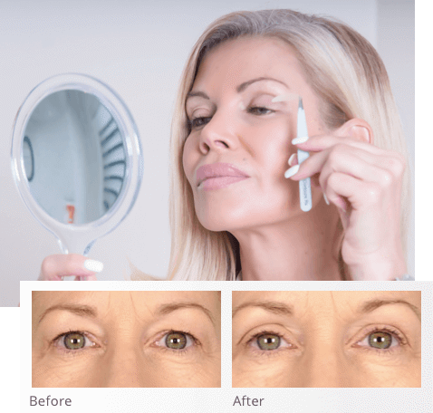 lids by design trial