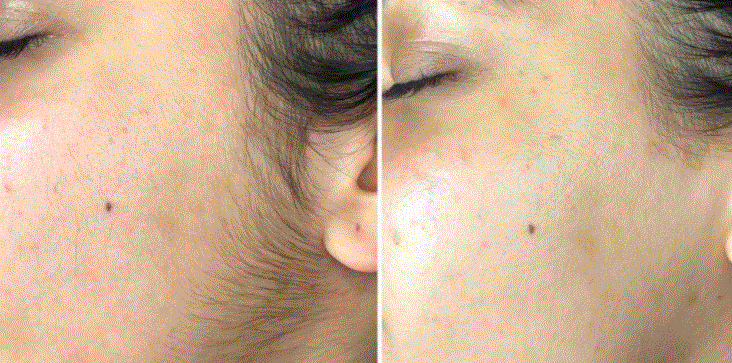 Dermal Blade (3 pack)
